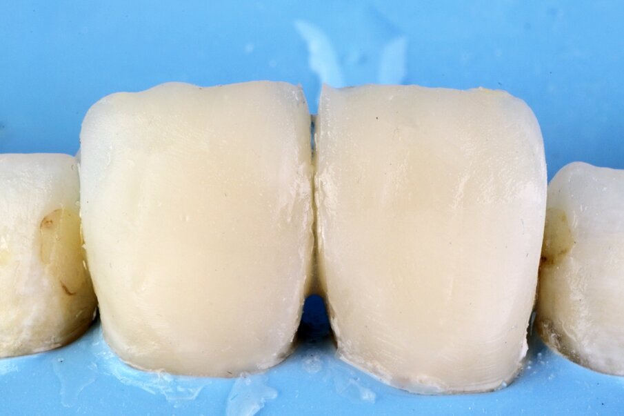 Fig. 12: Build-up of entire enamel layer with Beautifil II Enamel shade HVT.