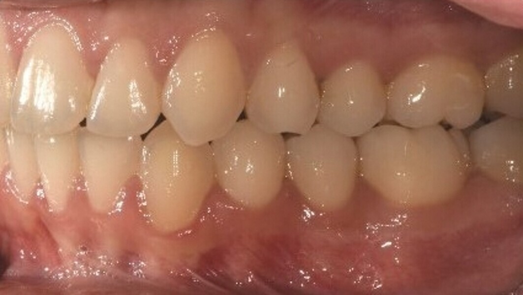 Fig. 6e : Photographie intraorale finale.