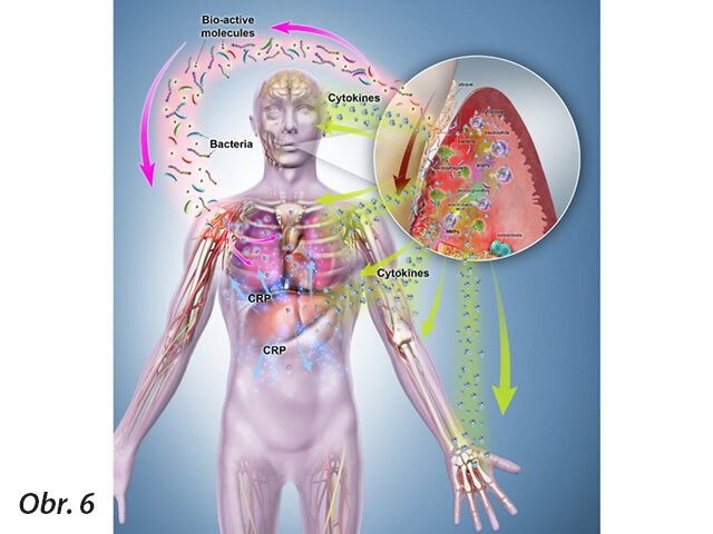 Obr. 6: Lokálně-systémové spojení: Lokální zánětlivý proces vytváří ulcerace v epiteliální výstelce parodontální kapsy, čímž vytváří riziko vzniku infekce vzdálených oblastí nebo bakteriémii. Systémové šíření lokálně produkovaných cytokinů ovlivňuje další orgánové systémy. Bakteriální rozptyl uvolňuje biologicky aktivní molekuly, které spouští reakci hostitele ve vzdálených oblastech, a zvyšuje hladinu cytokinů v séru. Tyto cytokiny následně ovlivňují cévy a orgány. CRP syntetizované v játrech jako reakce na cirkulující cytokiny dále poškozuje orgánové systémy.