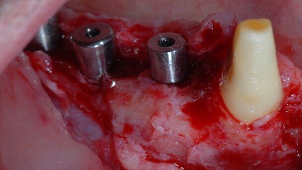 Valutazione clinica di un dispositivo riassorbibile “a cupola”, associato a GBR