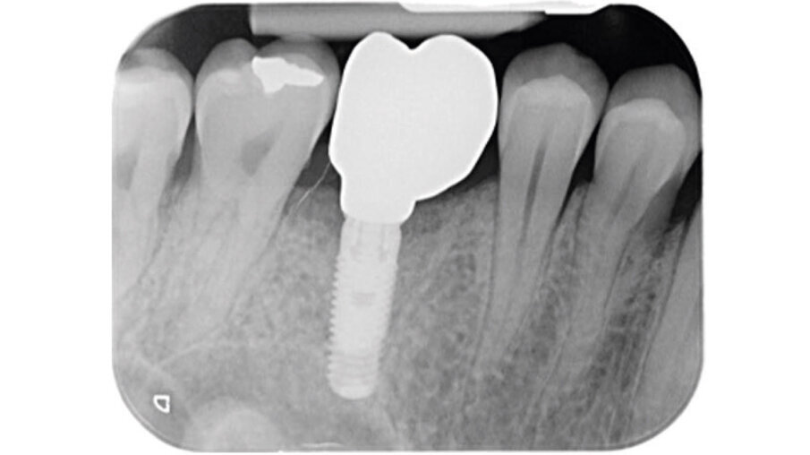 Fig. 12 - Radiografia di controllo a 2 anni.