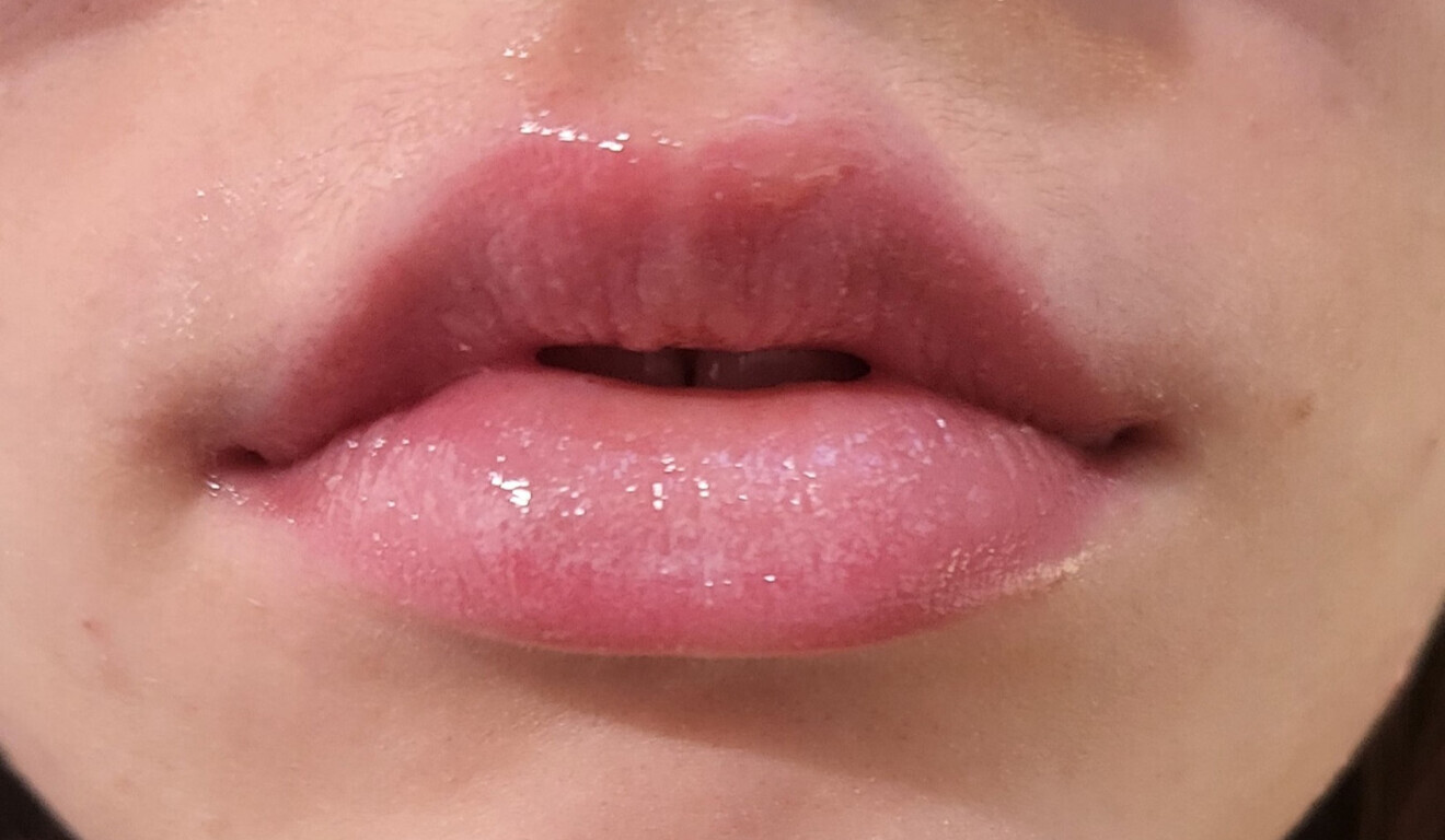 Fig. 2: Result after three laser treatment sessions.