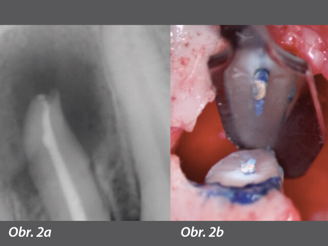 Axiální pohled na obturaci (mikrostrukturální replikace) ukazuje nedostatky na jednoduchém rentgenovém snímku. Významné oblasti v bukolingválním rozměru kořenového kanálku zůstaly nevyčištěny navzdory iluzornímu vzhledu na rentgenu.