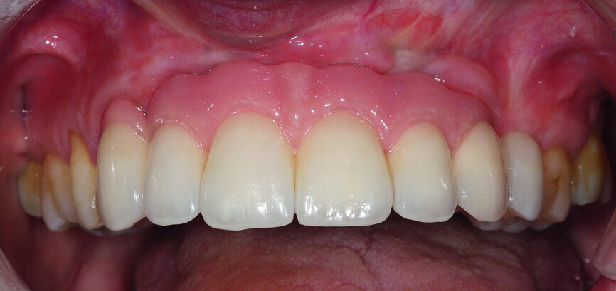 Fig. 36: Installation of the final prosthesis and verification of
correct occlusion. Screw channels filled with composite.
