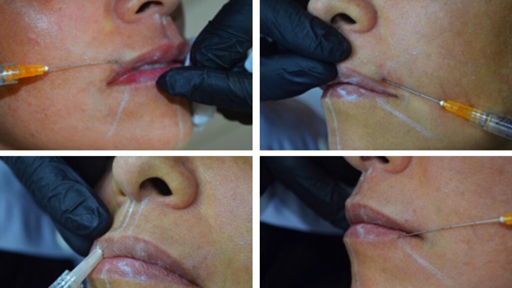 Dentistas y Médicos son los únicos que pueden usar botox y ácido hialurónico