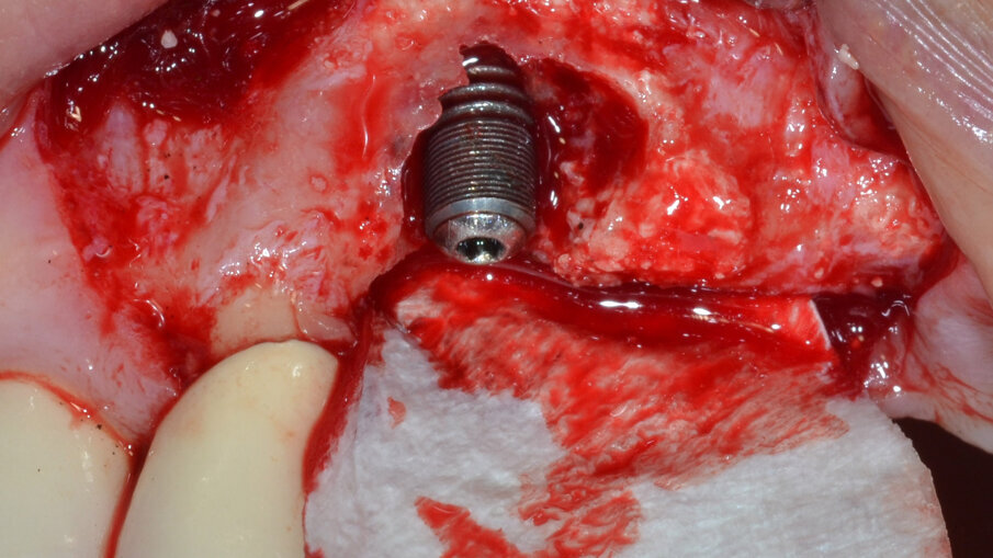 Fig. 8 - Innesto di un biovetro 45S5 in granuli all’interno del difetto.