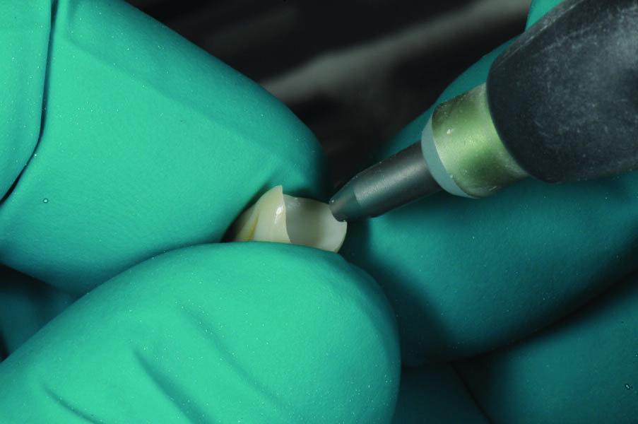Fig. 11: Pretreatment of the bonding surface of the zirconia crown with aluminum oxide (maximum 2 bar and a grain-size of 30 or 50 μm).