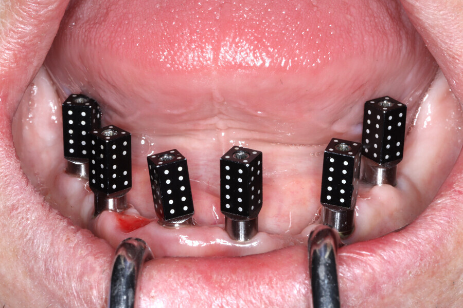 Fig. 15d: Photogrammetry scan bodies used to validate and confirm the Grammetry implant positions.