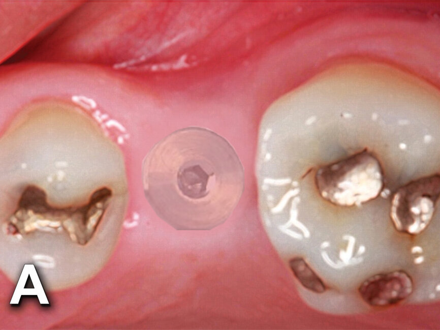 Figs. 4a: Implant to be uncovered (4a) presents with two options depending on width of attached gingiva available. Wide band of attached gingiva will remain after removal of tissue over cover screw, and the diode is utilized in a spiral pattern starting at center until fully exposed (4b). With the narrow band of attached gingiva present, an elliptical cut is made with the diode and tissue is pushed buccally and lingually to preserve the attached gingiva (4c). (Photo provided by Dr. Gregori M. Kurtzman)
