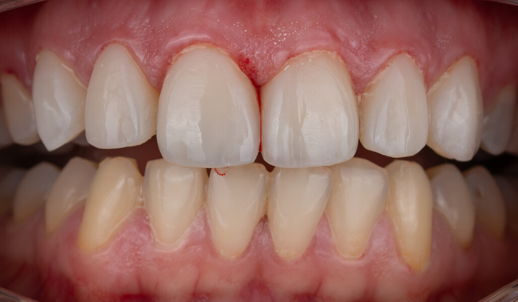 Fig. 8: Modified smile with more regular tooth forms and contours and a natural tooth shade.