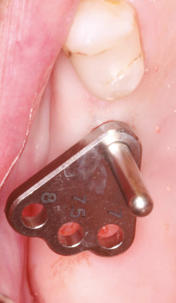 Fig.8: Optimal inter implant distance with the Axiom placement guide. 