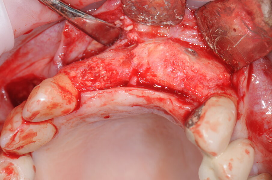 Fig. 16 - Esposizione del sito rigenerato in visione occlusale.