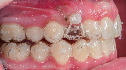 All buttoned up! Styling your plastic with elastics