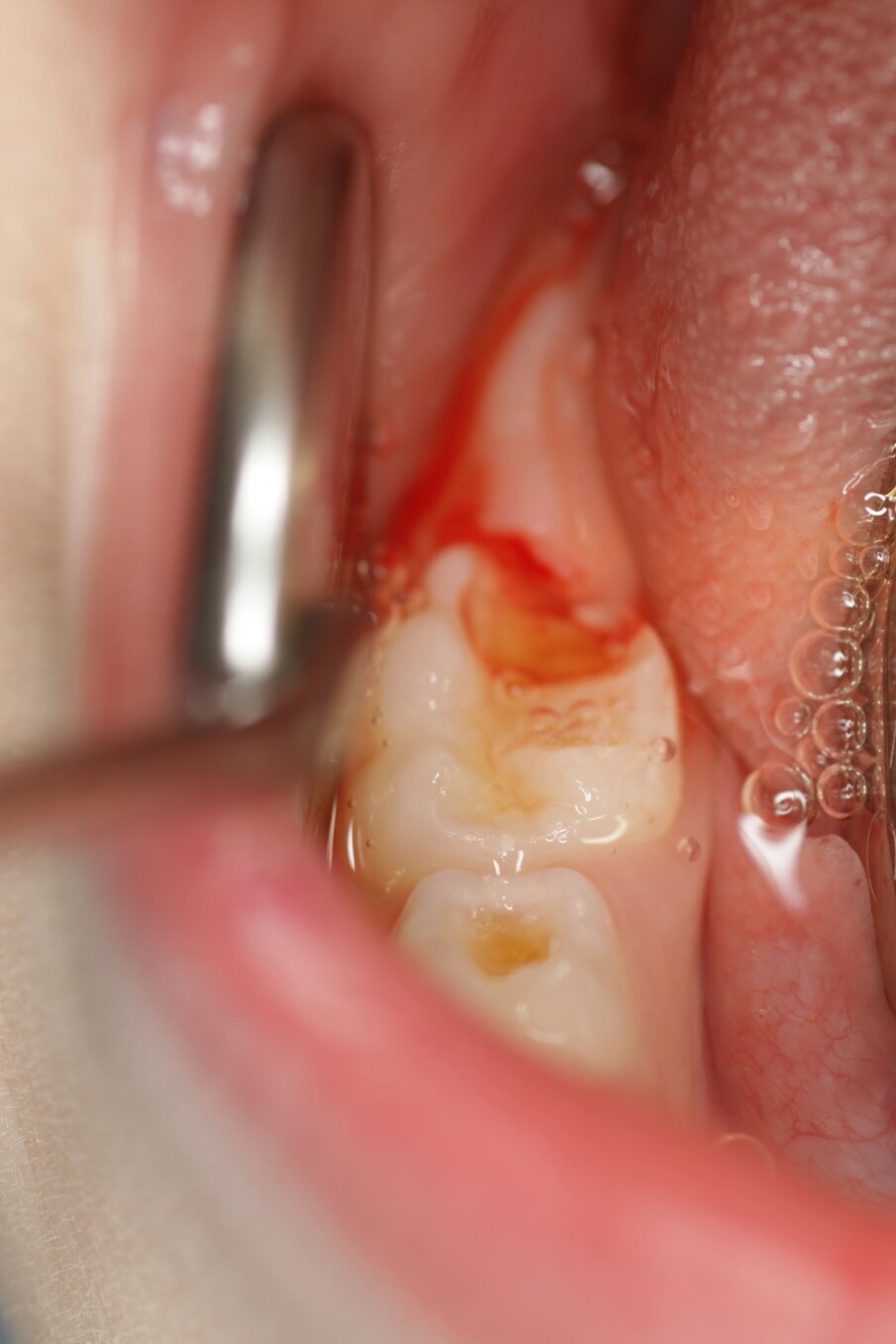 Afbeelding 3a. Cariëslaesies onderkaak rechts.