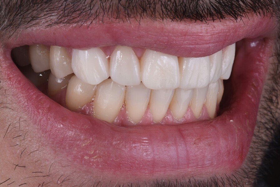 Figs. 8c-e: Anterior mock-up.