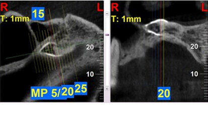 Detección y extracción de diente supernumerario Detección y extracción de diente supernumerario
