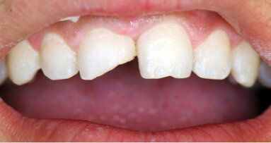 Nanohybridní kompozitní materiály: nejnovější třída kompozitních pryskyřic