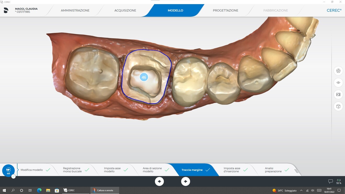 Fig. 5a: CAD workflow for tooth #46: definition of the preparation margin.