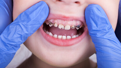 EFP reveals stunning global cost of gingivitis, caries, tooth loss