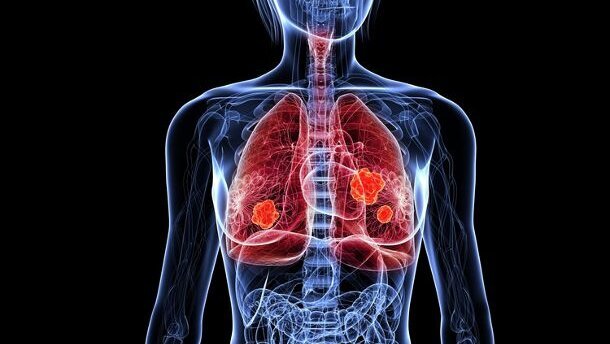 Krebsdiagnose durch Atemtest