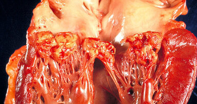 Endocarditis risk: Many German dentists ignore guidelines