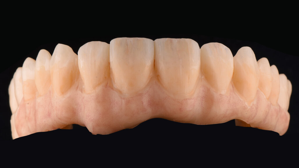 Micro‑layering for implant‑supported zirconia prostheses