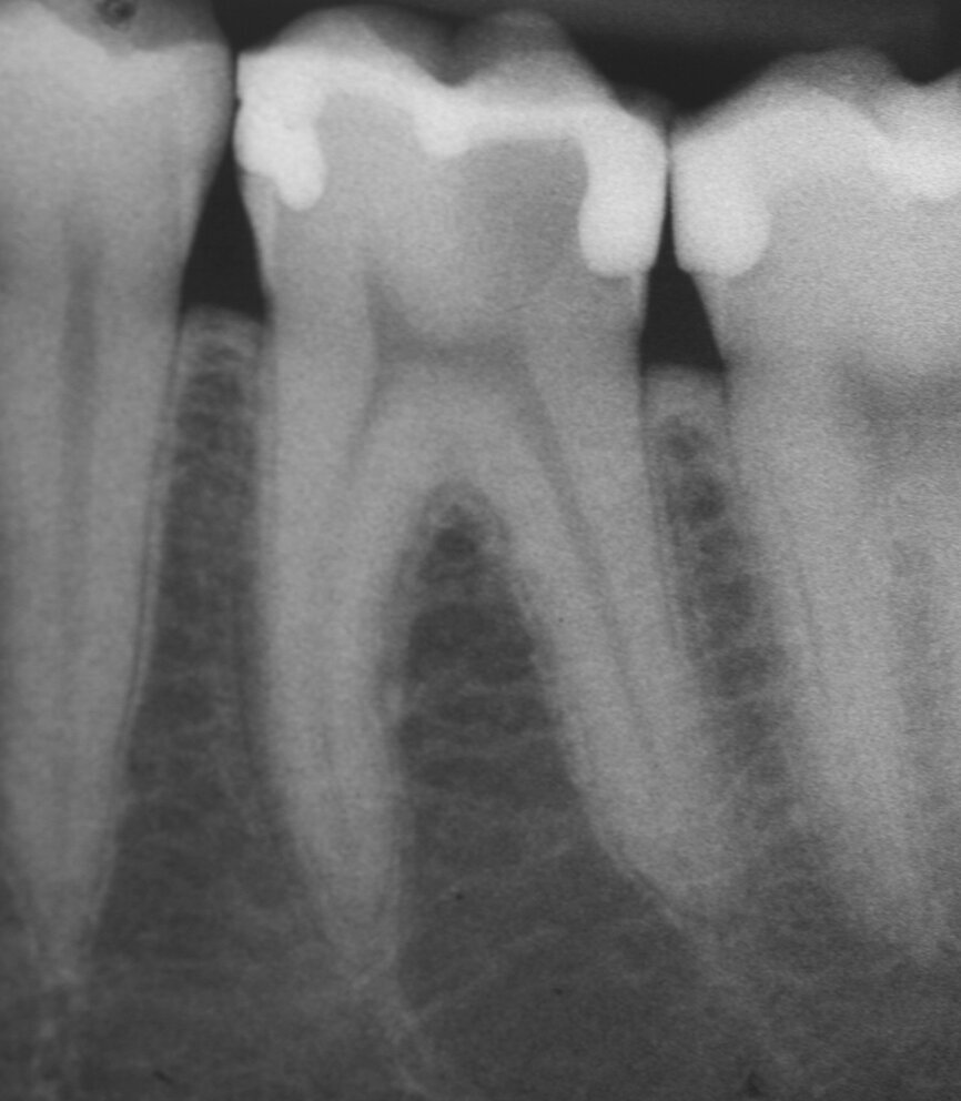 Fig. 1a: (a) Deep carious lesion. (b) Partial pulpotomy. (c) MTA application with the MAP System and PD MTA White. (d) Filling. (e) Post-op radiograph showing the pulp capping with MTA.