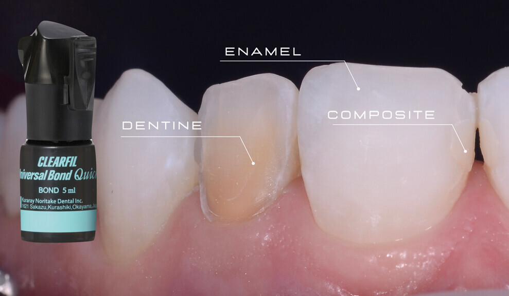 Fig. 1: CLEARFIL Universal Bond Quick establishes a strong bond to dentine, enamel and old composite.