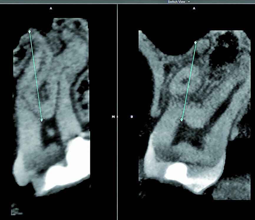 Fig. 7: The 3D Endo Software proposal of the canal anatomy that can be corrected by the operator, according to the canal configuration viewed in different planes in the software. In most cases, the proposal is very good but in this case it was not accurate because of the multi-planar canal anatomy.