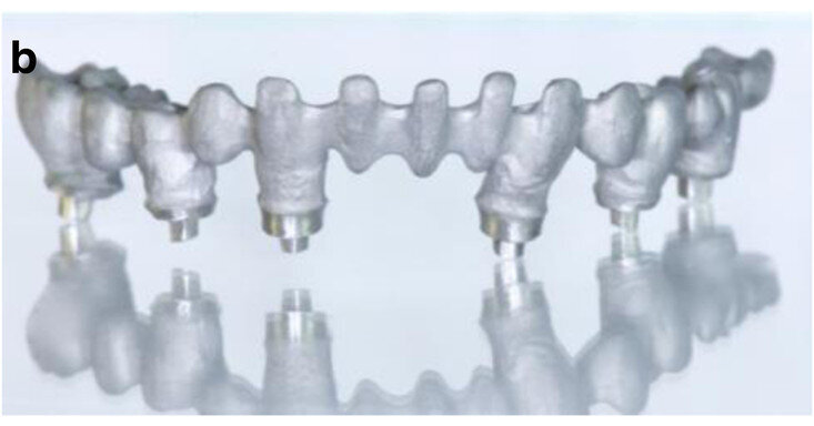 Fig. 13b: CAD/CAM-fabricated one-piece cobalt–chromium framework before (a & b) and after veneering with composite (SR Nexco Paste, Ivoclar Vivadent), that is the final FDP (c & d).
