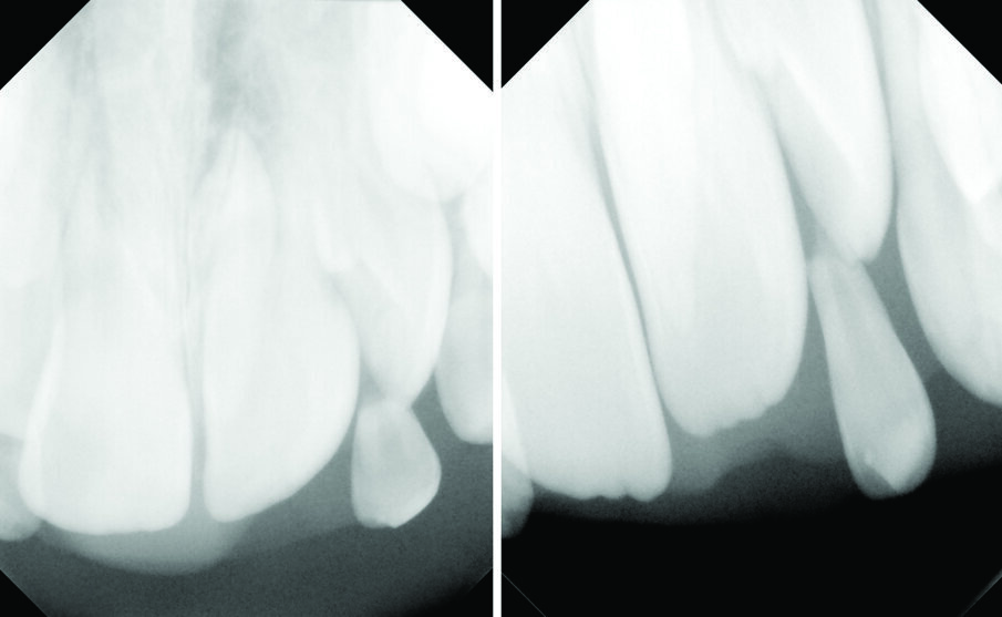 Figs. 3 (a & b). Periapical xrays show the presence of an inverted conical supernumerary tooth present palatally to 21 (parallax).