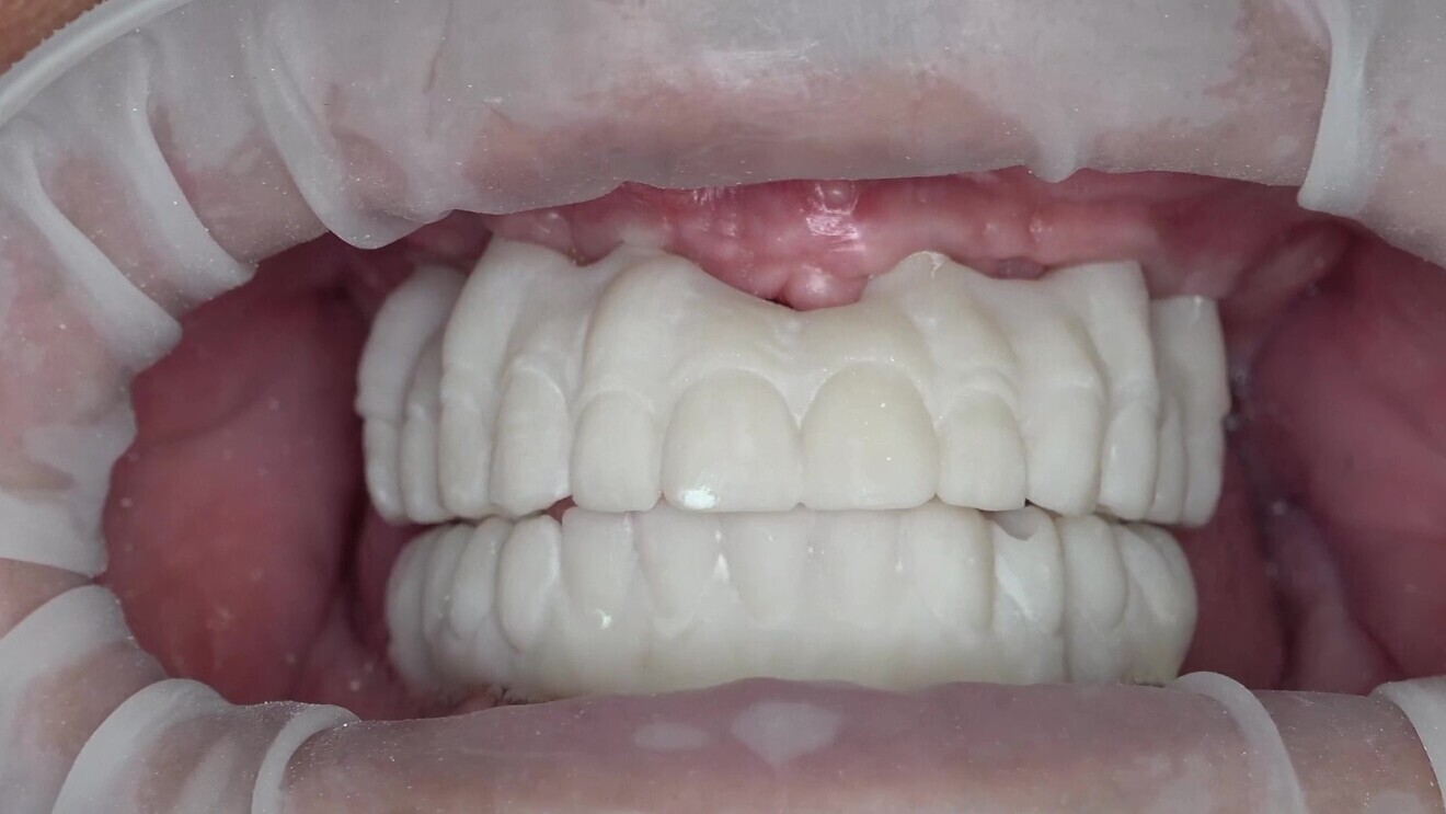Fig. 12: The patient wearing the nal try-ins. OptraGate was used to simplify the photography process.