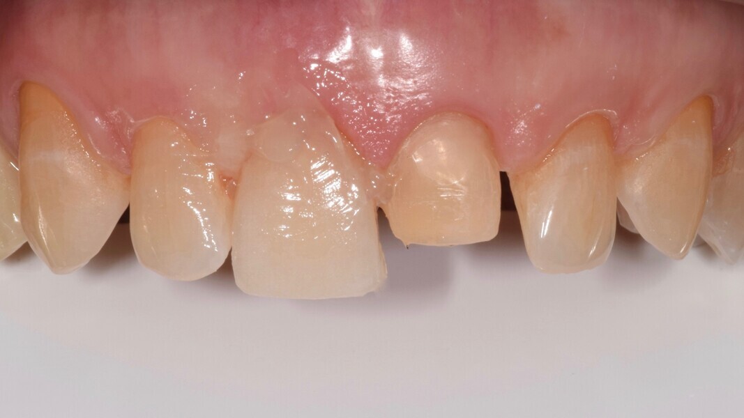 Fig. 4: Veneer try-in.