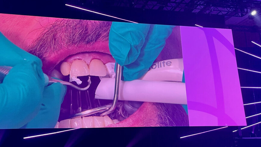 Live demonstration by Dr Meena Barsoum during the general session. (Image: Dental Tribune International)