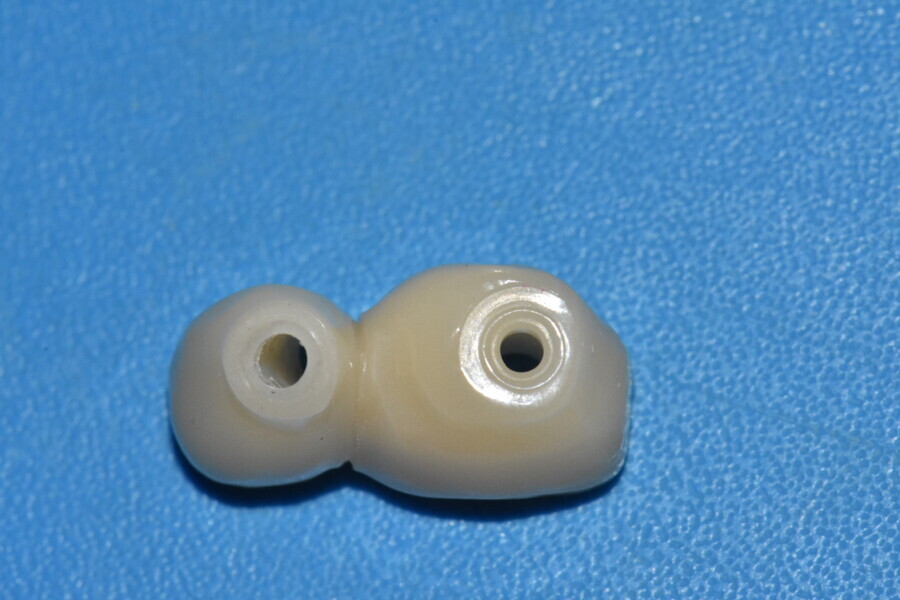 Fig. 11c : Bridge G-CAM réalisé en direct implants avec vis sphériques.