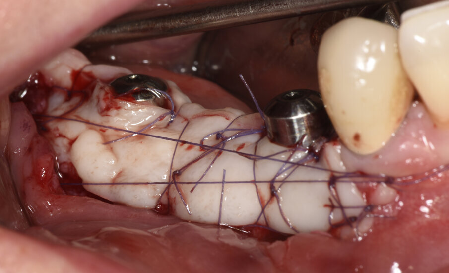 Fig. 11_Vestiboloplastica con innesto epitelio connettivale per aumentare la banda di mucosa cheratinizzata intorno agli impianti.