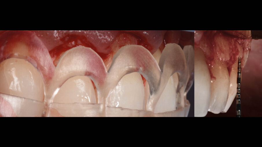 Fig. 13_La guida favorisce la chirurgia ossea resettiva.