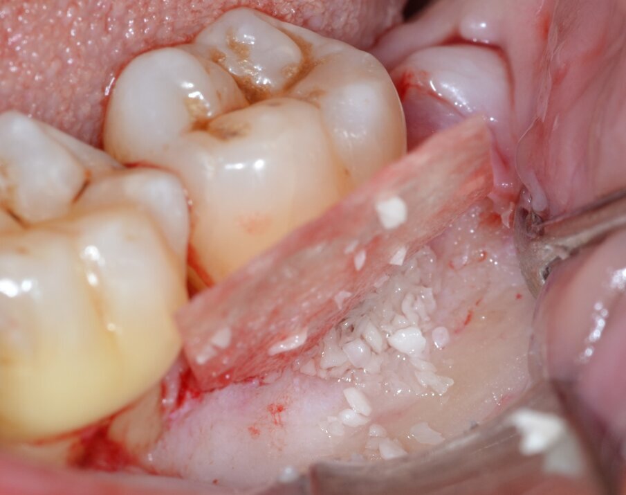 Fig. 10 - Innesto di biomateriale eterologo.