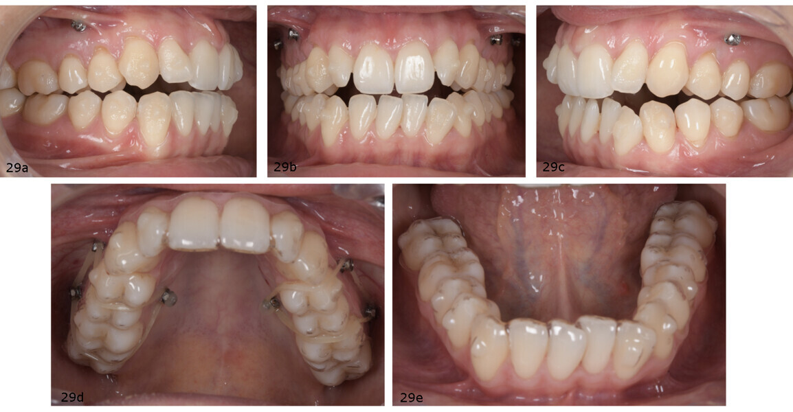 Figs. 29a–e: Situation after placement of the maxillary and mandibular attachments and mini-screws (a–c). Mandibular aligner after placement of the attachments (d). Elastics over the maxillary aligner (e).