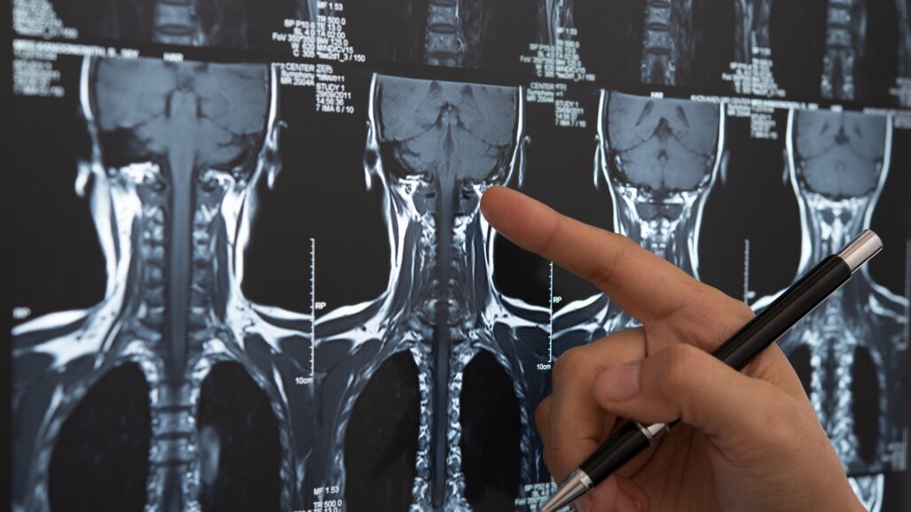 Back scatter: Understanding the implications of radiotherapy for dental implants in head and neck cancer patients