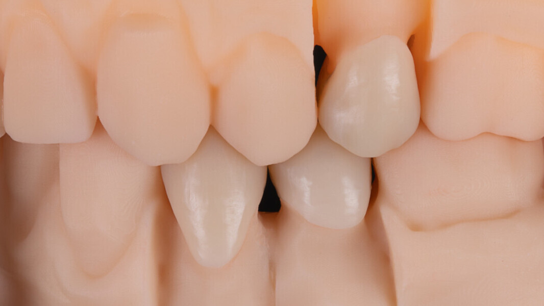 Fig. 11: The crowns on the model before individualisation by means of the painting technique.