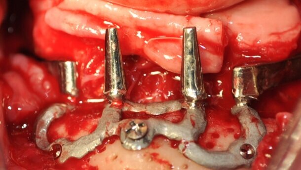 Implant ramowy podokostnowy w chirurgii implantologicznej – opis przypadku.