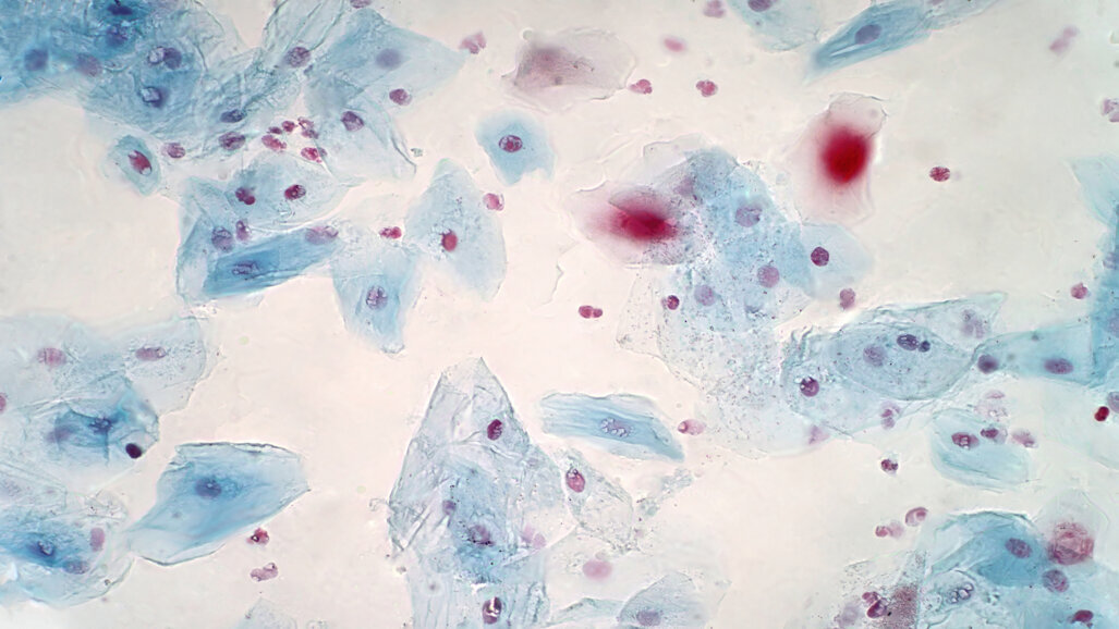 Britanski istraživači identificirali su bakterije sposobne uništiti rak glave i vrata