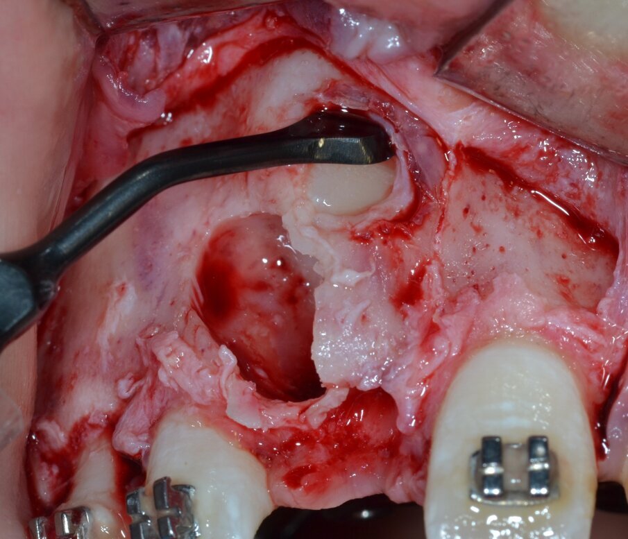 Fig. 13_Esposizione chirurgica della corona dentaria di 1.1.