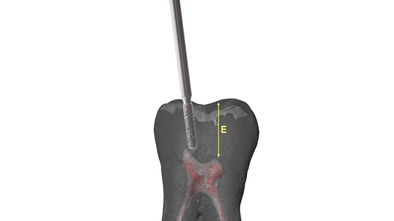 Fig. 14: View of the bur (#880-314-012) used for the penetration step on a micro-CT scan of a mandibular molar. E = buccal cusp to pulp chamber roof. (Image: © Elio Berutti)