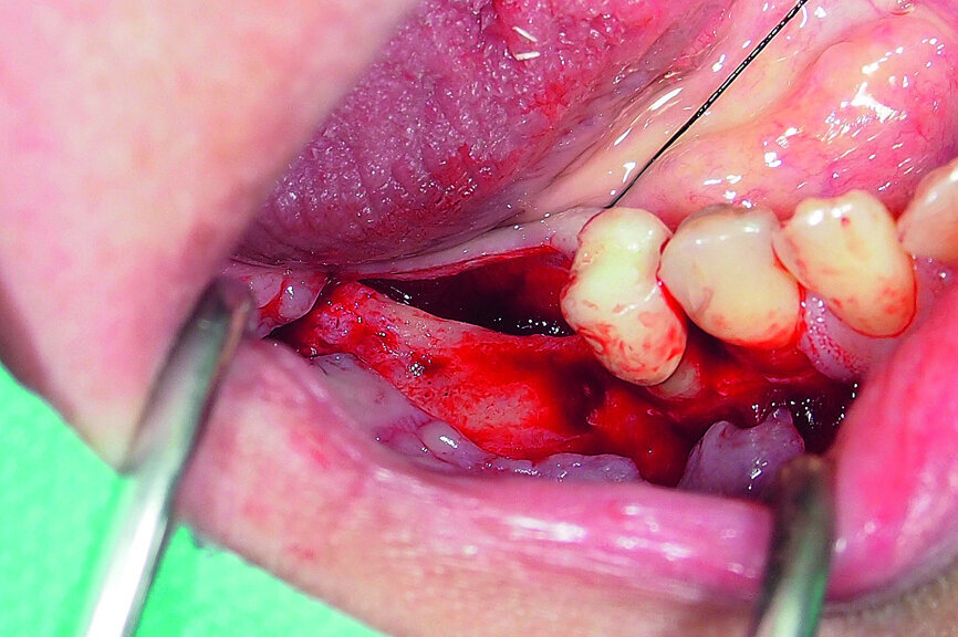 Fig. 15: Combination of full- and partial-thickness flap elevation.