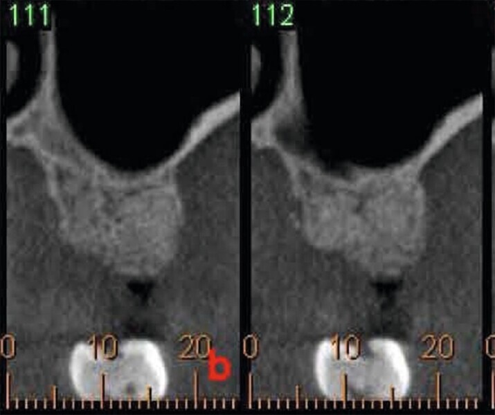 Fig. 3 : Cicatrisation de l’alvéole préservée.