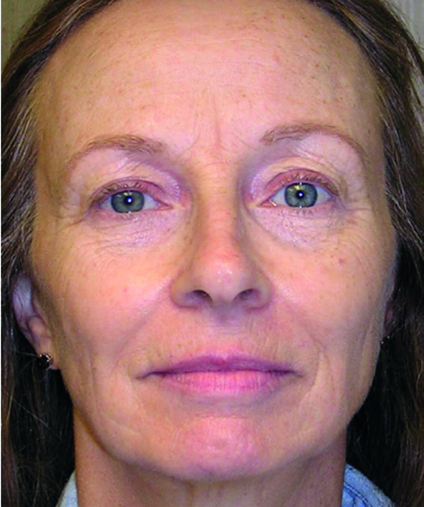 Fig. 7 b : Photographies du visage avant et après.