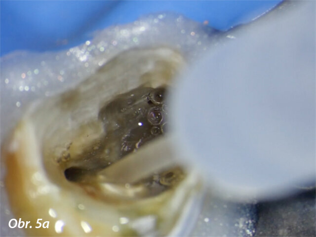 Flexibilní konec vylepšuje ergonomii výplachu a umožňuje oplach kanálkového systému u zubů se složitou anatomií