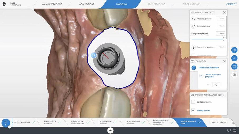 Fig. 24_Maschera gengivale disegno della linea base.
